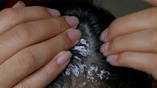 ASMR Satisfying Scalp Cleanse & Dandruff Removal #S0002