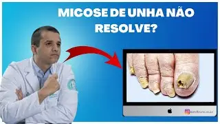 Tratamento de micose de unha - Dr. Bruno Souza dermatologista