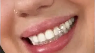 Diy tooth gems at home with a professional kit