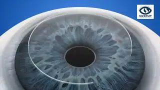 Flap Patient Education | Susrut Eye Foundation