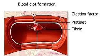 Disseminated Intravascular Coagulation ; Definition, Causes, Symptoms, Diagnosis, Treatment