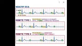 MOBITZ TYPE 1 and MOBITZ TYPE 2 ECG