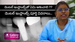 డెంటల్ ఇంప్లాంట్ గురుంచి పూర్తి వివరాలు  | Best Dental Hospital Clinic In Hyderabad