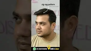 5 Years Later: Real Results & Live Review of 3500 Grafts Hair Transplant by Dr. Suneet Soni