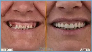 Rasti me 7 Implante Dentare - 7 Dental Implants Case - 7 Caso di impianti dentali