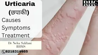 Urticaria || छपाकी || Homoeopathic medicine || Dr Neha Saklani