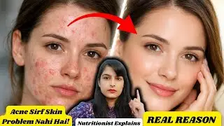 Acne Sirf Skin Problem Nahi Hai | Hormonal Acne Explained by Nutritionist #hormonalacne #acnetruth