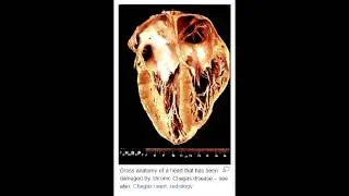 Lab or Diagnostic Findings: Chagas Disease (Trypanosoma Cruzi)