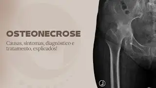 Osteonecrose- Causas, sintomas, diagnóstico e tratamento- Dr. Isaías Chaves