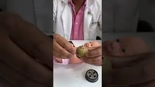 #acupuntura #medicinachina #moxibustion