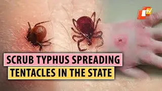 Scrub Typhus Cases Jump To 183 In Odisha&rsquo;s Sundargarh, Total Deaths In State At 7