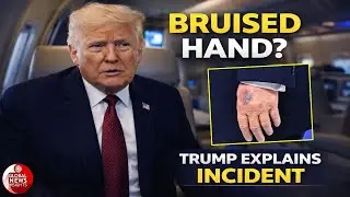 Trump Finally Explains the Big Hand Bruise &mdash; &ldquo;Here&rsquo;s What Happened&rdquo;
