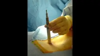 MIS  POSTERIOR STABILISATION - BURST FRACTURE LUMBAR SPINE