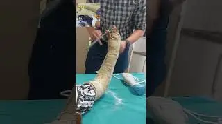 cast removal