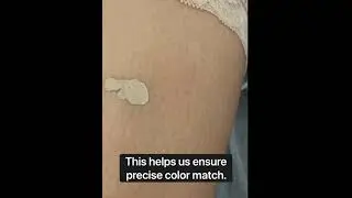 Childhood scar remedy with before and after. Camouflage Tattoo. Nue Conceal