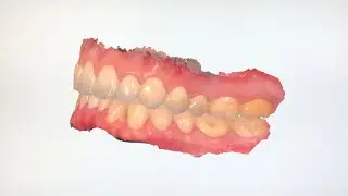 Dental 3D Digital Scanning Impressions