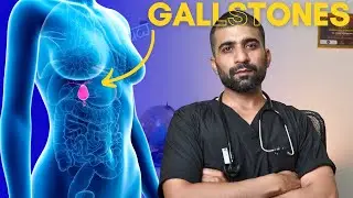 Gall Bladder Stone Surgery Diet| Doctor Explains 🚨