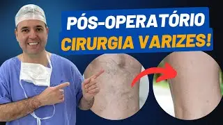 P&oacute;s-operat&oacute;rio da cirurgia de VARIZES - Dr. Alex Vascular
