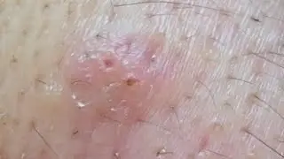 Popping My Own Pimples | Sebum Squeeze & Self-Extraction #60 #sebum #acne #pimple #pimplepopping 