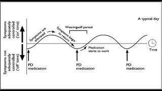 Meaning of On Off Phenomenon of Levodopa Drugs in Treatment of Parkinson's Disease