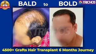 4500+ Grafts FUE Hair Transplant 6 Months Journey | TRICHOS | Dr.John Watts