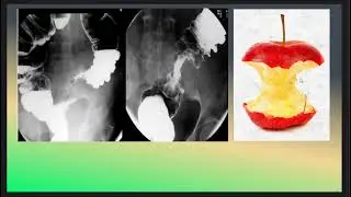 Apple Core Sign