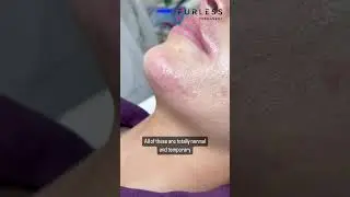 Furless Permanent Hair Removal via Electrolysis | Temporary Side Effects Are Normal