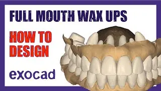 Full Mouth Wax-Up Tutorial | Step-by-Step ExoCAD Design