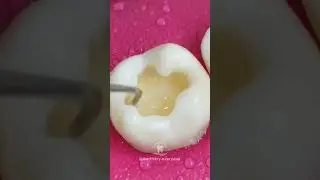 Dental motivation. Direct composite restoration teeth. Dental anatomy. #dentistry  #composite
