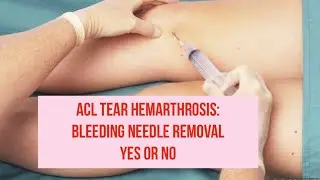 ACL TEAR HEMARTHROSIS: bleeding needle removal YES or NO