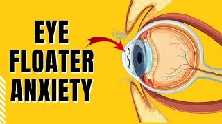 How to stop worrying about floaters in eyes