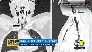Man hospitalized after holding back sneeze
