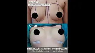 Breasts Augmentation with Implants #results #boobs #shorts
