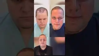 Таиланд или Турция: где лучше всего сделать пересадку волос? Мой опыт