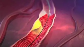 LipiScan Coronary Imaging System