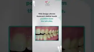 Before after Open Bite and Posterior CrossBite  #braces #crowding