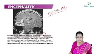Encephalitis (Hindi) : Internal Medicine