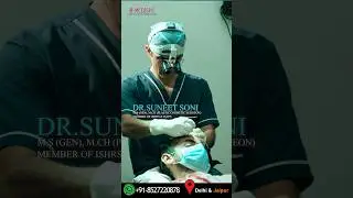 5000 Grafts Hair Transplant Results in India in Level 6 by Dr Suneet Soni  #hairtransplantresults