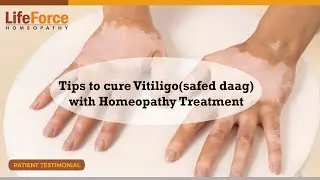 Vitiligo Skin Care Tips By Expert Homeopath Dr. Rajesh Shah | Effective Homeopathy Treatment