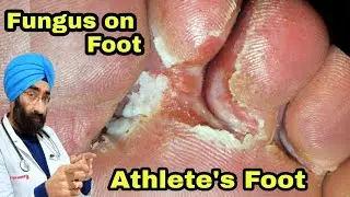 Athlete's foot | Fungal Foot Infection | Tinea pedis | 100% Science | Dr.Education (ENG)