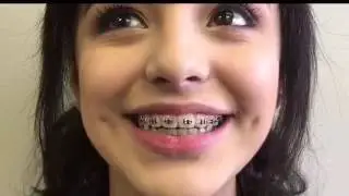 Orthodontist  Why Braces - Advanced Orthodontic