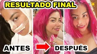 ♥️RESULTADO FINAL DE MI CIRUGÍA DE NARIZ💕 ¡LA AMO! 🙋🏻‍♀️ |Conny Merlin