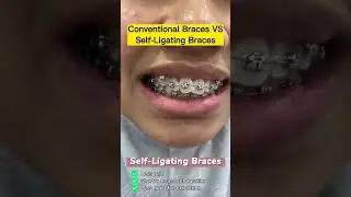 Conventional Braces vs Self-Ligating Braces - Which One Should You Choose?