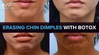 Get Rid of Chin Dimples with BOTOX&reg; | Mabrie Facial Institute in San Francisco, CA