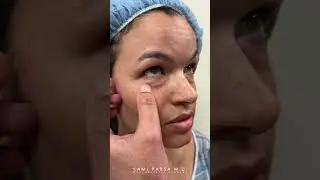 Should You Remove CHEEK FILLER Before Trifecta Lift? | Lower Eyelid Surgery with Dr. Kami Parsa