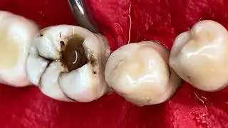 The dentist is examining the cavity | Can your decayed tooth be saved?