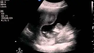 11 weken + 4dagen echo