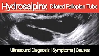 Unilateral Fallopian Tube Blockage ( Hydrosalpinx ) Infertility | Ultrasound Diagnosis - Causes
