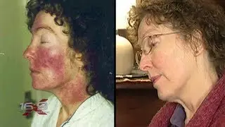16x9 - Rays of Rash: Toxic light bulb investigation [Part 1]
