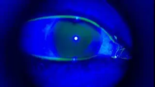 Abnormal Tear Film Break-Up Time (TBUT) on PSL D20